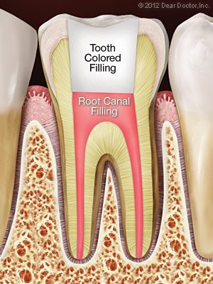 Filling After Root Canal 