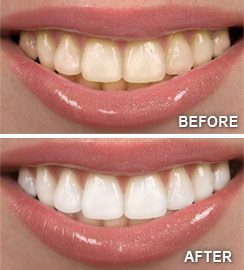 Before and After Teeth Whitening 