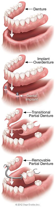 Removable Denture Types 