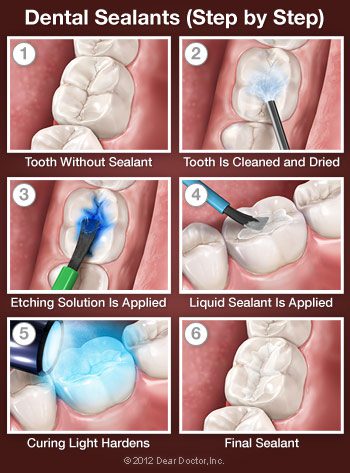 Dental sealants treatment
