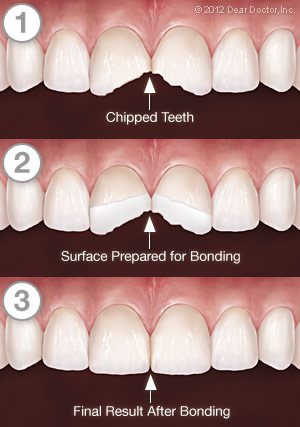 Tooth Bonding process