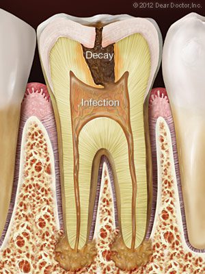 Decayed and infected tooth