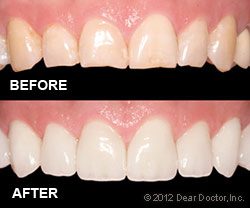 Veneers Before and After image 